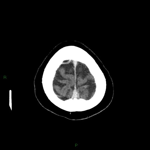 File:Cerebral metastasis from renal cell carcinoma (Radiopaedia 82306-96375 Axial C+ delayed 37).jpg