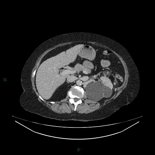 File:Cerebral metastasis from renal cell carcinoma (Radiopaedia 82306-96378 A 59).jpg