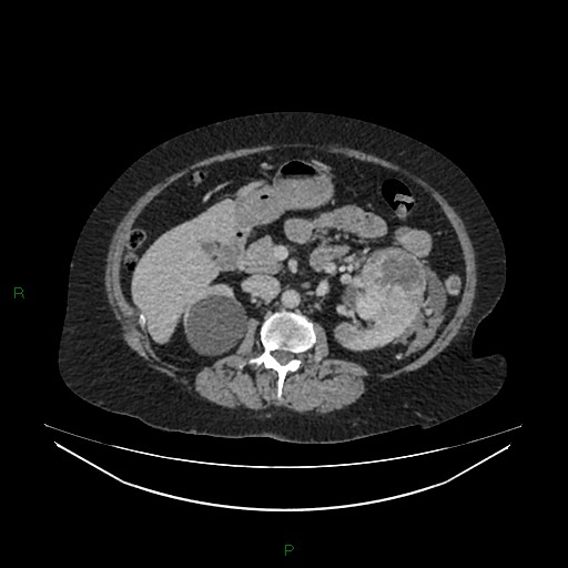 Cerebral metastasis from renal cell carcinoma (Radiopaedia 82306-96378 A 71).jpg