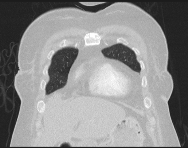File:Cerebral metastasis to basal ganglia (Radiopaedia 81568-95414 Coronal lung window 20).png