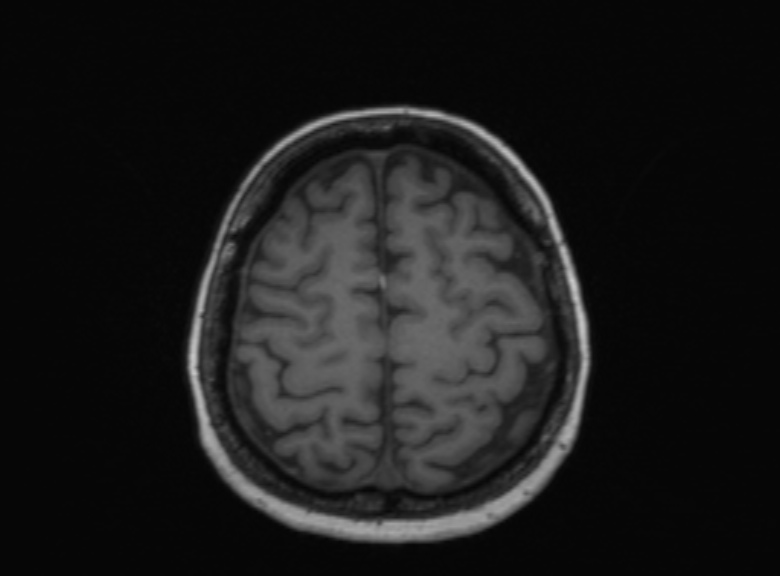 Cerebral ring enhancing lesions - cerebral metastases (Radiopaedia 44922-48817 Axial T1 144).jpg
