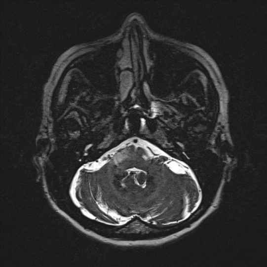 Cerebral ring enhancing lesions - cerebral metastases (Radiopaedia 44922-48817 F 24).jpg