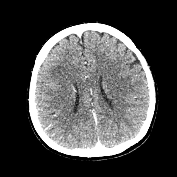 Cerebral ring enhancing lesions - cerebral metastases (Radiopaedia 44922-48818 B 182).jpg