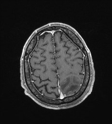 Cerebral toxoplasmosis (Radiopaedia 43956-47461 Axial T1 C+ 64).jpg