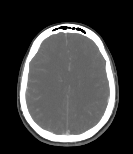 Cerebral venous hemorrhagic infarction (Radiopaedia 38461-40550 Axial MIP VENOGRAM 35).png