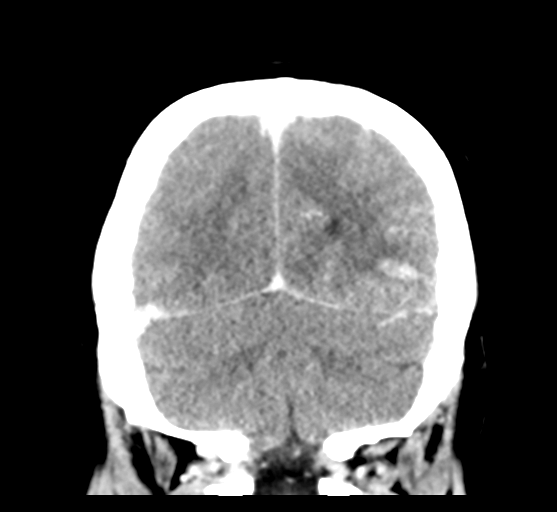 Cerebral venous hemorrhagic infarction (Radiopaedia 57576-64538 Coronal C+ 49).png