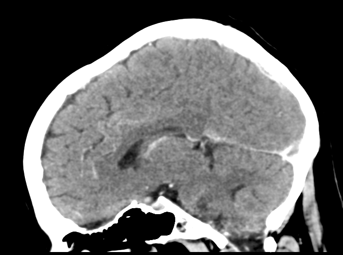 Cerebral venous hemorrhagic infarction (Radiopaedia 57576-64538 Sagittal C+ 29).png