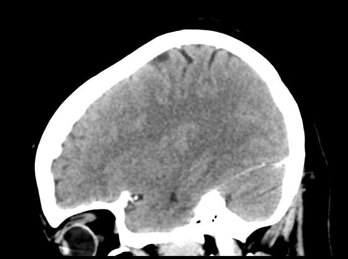 Cerebral venous hemorrhagic infarction (Radiopaedia 57576-64538 Sagittal C+ 38).png