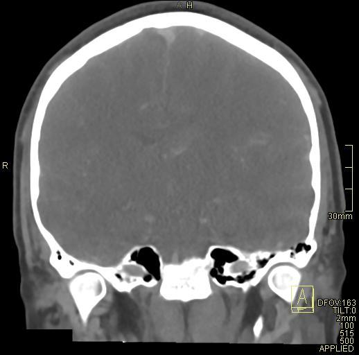 File:Cerebral venous sinus thrombosis (Radiopaedia 91329-108965 Coronal venogram 47).jpg