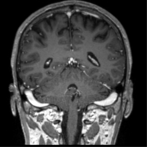 Cerebral venous thrombosis (Radiopaedia 38392-40469 Coronal T1 C+ 30).png