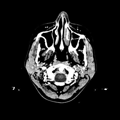 File:Cerebral venous thrombosis with venous hemorrhagic infarct (Radiopaedia 90354-107660 Axial with contrast 2).jpg