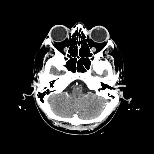 Cerebral venous thrombosis with venous hemorrhagic infarct (Radiopaedia 90354-107660 Axial with contrast 36).jpg