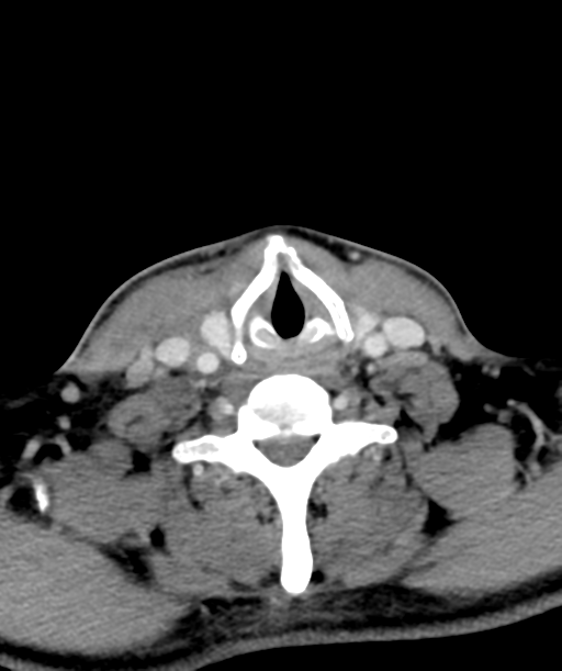 Cervical abscess (Radiopaedia 43725-47184 A 49).png