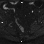 Cervical adenocarcinoma (Radiopaedia 65011-73985 Axial DWI 68).jpg