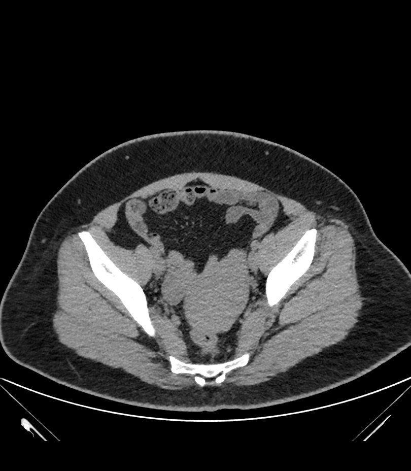 Cervical aortic arch with coarctation and aneurysms (Radiopaedia 44035-47552 Axial non-contrast 86).jpg