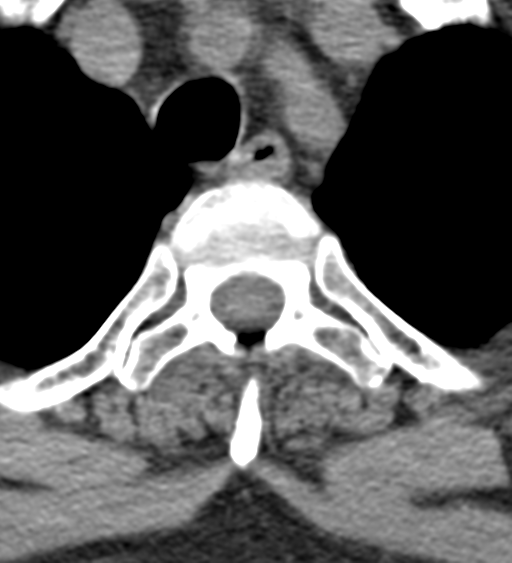 Cervical canal stenosis - OPLL and osteophytes (Radiopaedia 47329-51910 Axial non-contrast 65).png