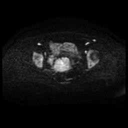 File:Cervical carcinoma (Radiopaedia 88010-104555 Axial DWI 50).jpg