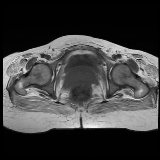 File:Cervical carcinoma (Radiopaedia 88010-104555 Axial T1 16).jpg