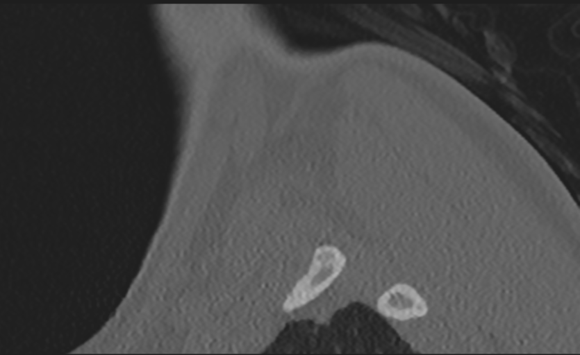 Cervical disc replacement (Radiopaedia 37383-39205 Sagittal bone window 3).png