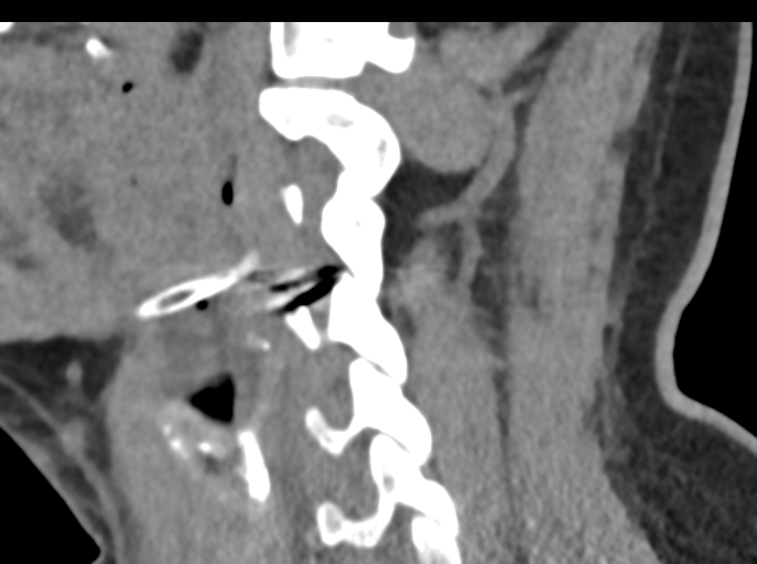 File:Cervical disc replacement (Radiopaedia 44025-47541 B 63).png