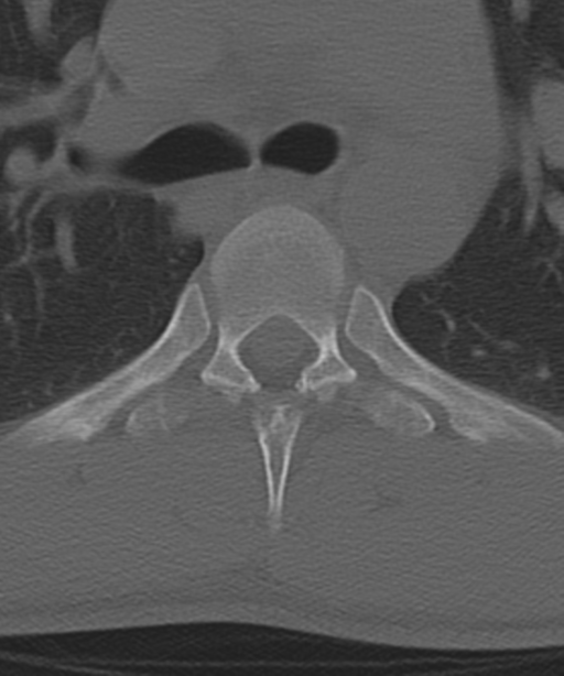 Cervical intercalary bone (Radiopaedia 35211-36748 Axial bone window 86).png