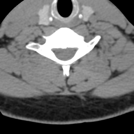 Cervical schwannoma (Radiopaedia 57979-64974 Axial non-contrast 47).png