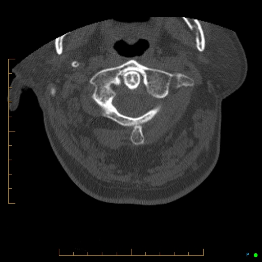 Cervical spine fracture - ankylosing spondylitis (Radiopaedia 76835-88706 Axial bone window 32).jpg