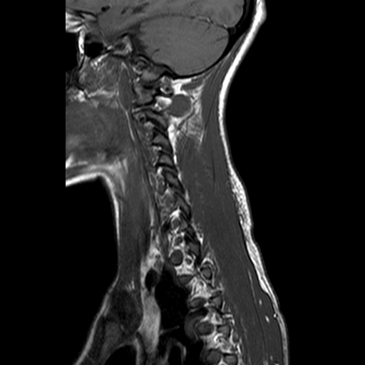 File:Cervical spine posterior ligamentous complex rupture (Radiopaedia 63486-72103 Sagittal T1 12).jpg