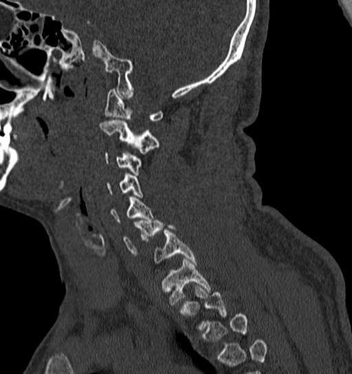 Cervical spine trauma with tear drop fracture and perched facet joint (Radiopaedia 53989-60127 Sagittal bone window 117).jpg
