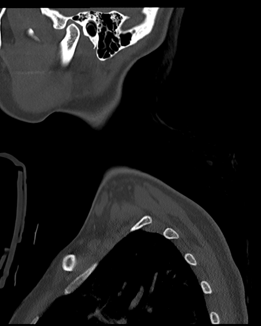Cervical tuberculous spondylitis (Radiopaedia 39149-41365 Sagittal bone window 4).png