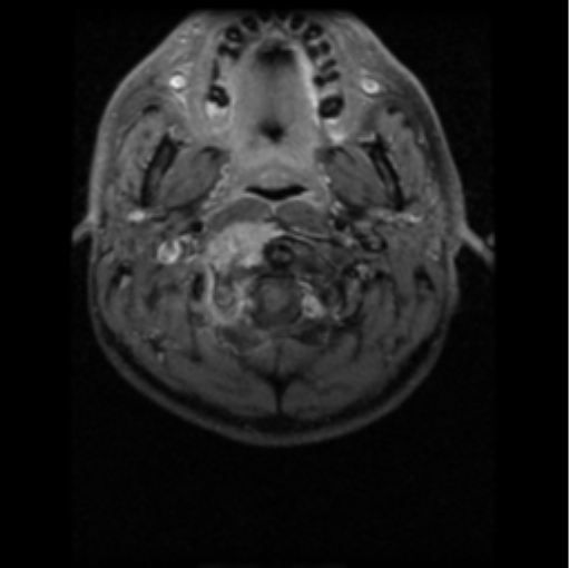 File:Cervical vertebrae metastasis (Radiopaedia 78814-91667 Axial T1 C+ fat sat 12).png