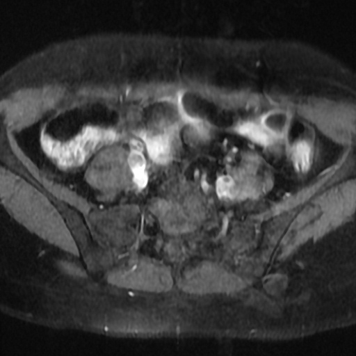 File:Cesarian section scar endometriosis (Radiopaedia 66520-75799 Axial T1 fat sat 1).jpg