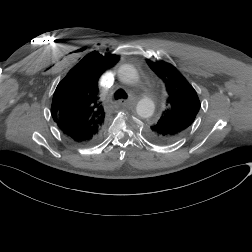 File:Chest multitrauma - aortic injury (Radiopaedia 34708-36147 A 102).png
