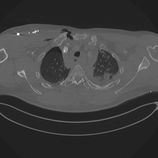 Chest multitrauma - aortic injury (Radiopaedia 34708-36147 Axial bone window 61).png
