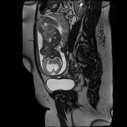 File:Chiari II malformation - fetal MRI (Radiopaedia 68099-77581 Sagittal Fiesta 20).jpg