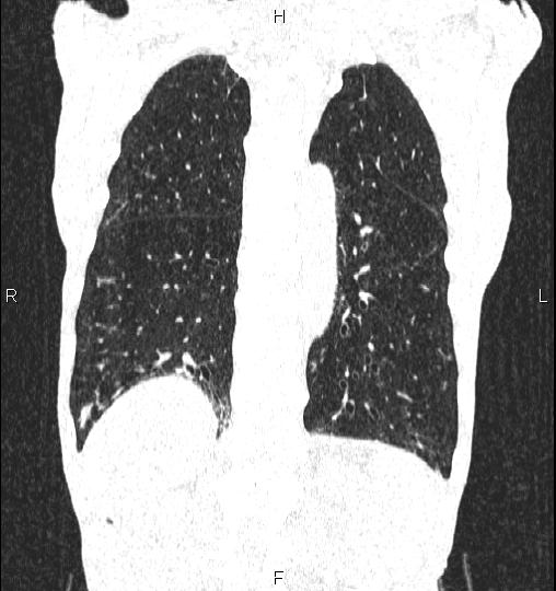 Chilaiditi sign (Radiopaedia 88839-105611 Coronal lung window 49).jpg
