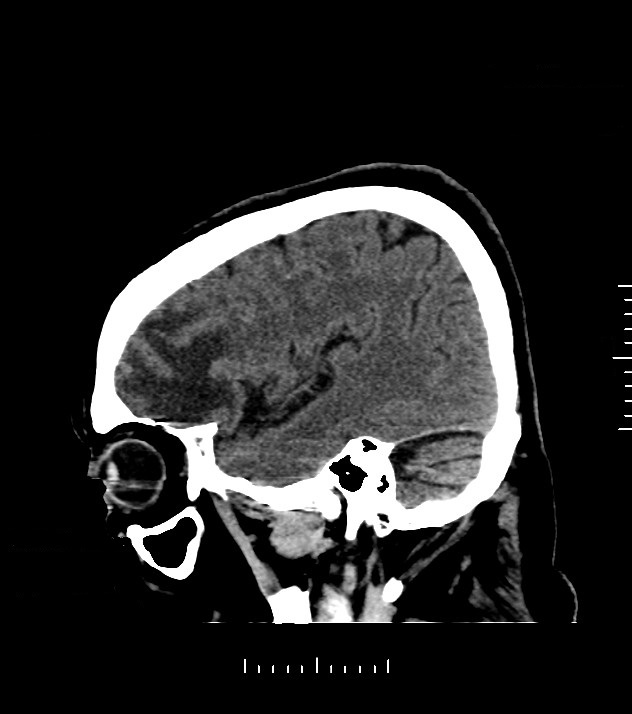 Cholangiocarcinoma with cerebral metastases (Radiopaedia 83519-98628 C 43).jpg