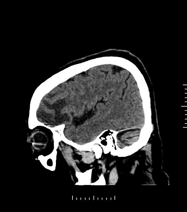 Cholangiocarcinoma with cerebral metastases (Radiopaedia 83519-98628 C 44).jpg