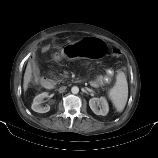File:Cholangitis and abscess formation in a patient with cholangiocarcinoma (Radiopaedia 21194-21100 A 22).jpg