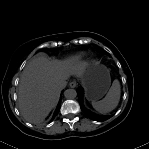 File:Cholecystitis - obstructive choledocholitiasis (CT intravenous cholangiography) (Radiopaedia 43966-47479 Axial 115).png