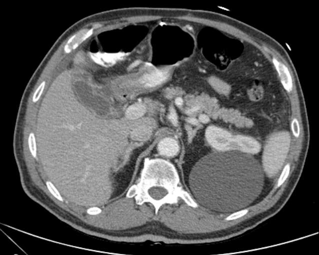 Cholecystitis - perforated gallbladder (Radiopaedia 57038-63916 A 27).jpg