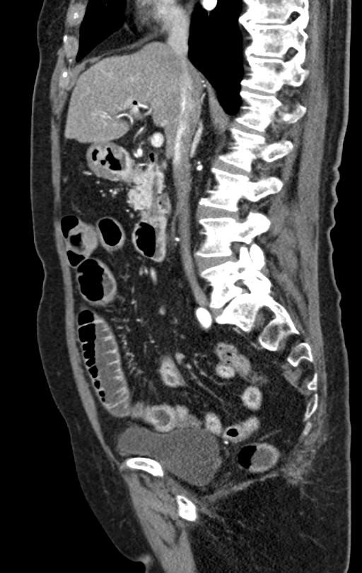 Cholecystoduodenal fistula due to calculous cholecystitis with gallstone migration (Radiopaedia 86875-103077 C 36).jpg
