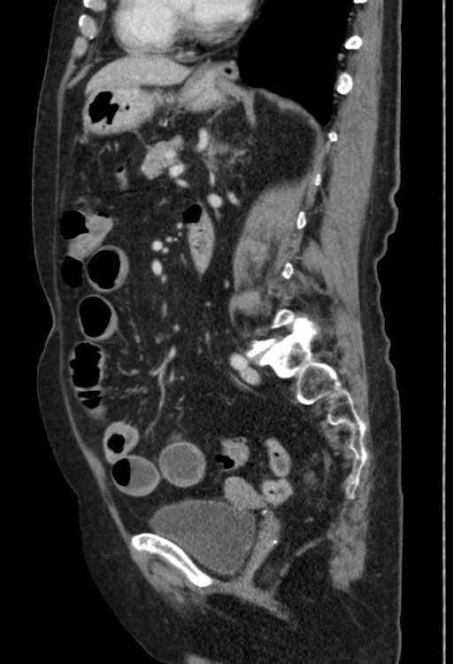 Cholecystoduodenal fistula due to calculous cholecystitis with gallstone migration (Radiopaedia 86875-103077 F 25).jpg