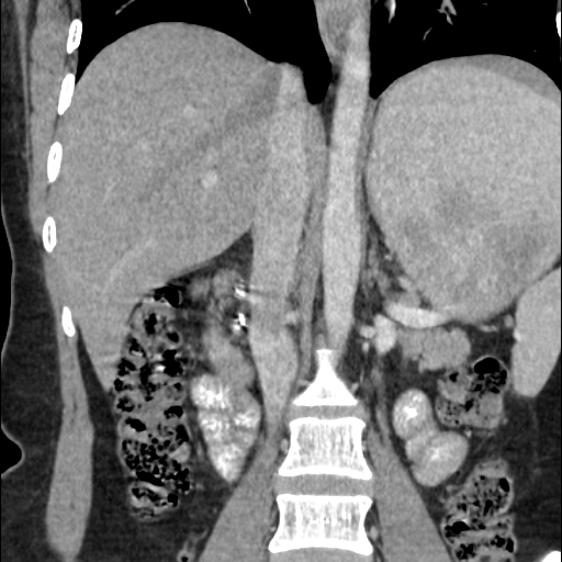 File:Choledochal cyst with chronic calcific pancreatitis (Radiopaedia 18245-18061 B 13).png