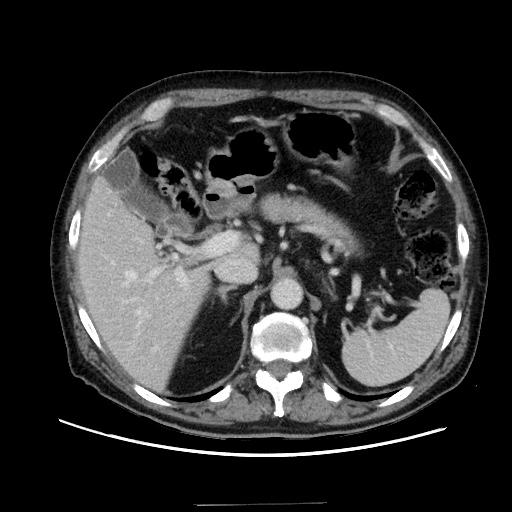 Choledocholiathiasis with normal caliber common bile duct (Radiopaedia 75368-86632 A 57).jpg