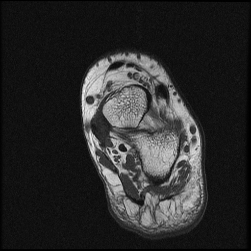File:Chondroblastoma - midfoot (Radiopaedia 64831-73765 Short axis T1 5).jpg