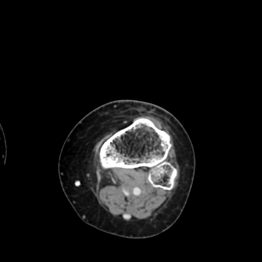 Chondrosarcoma - femur (Radiopaedia 64187-72954 Axial with contrast 71).jpg