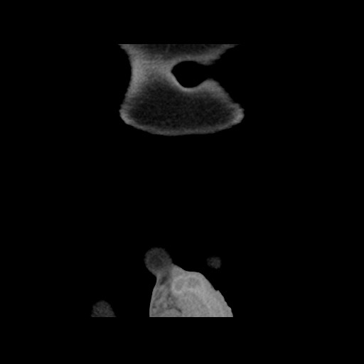 Chondrosarcoma of iliac wing (Radiopaedia 63861-72599 Coronal non-contrast 12).jpg