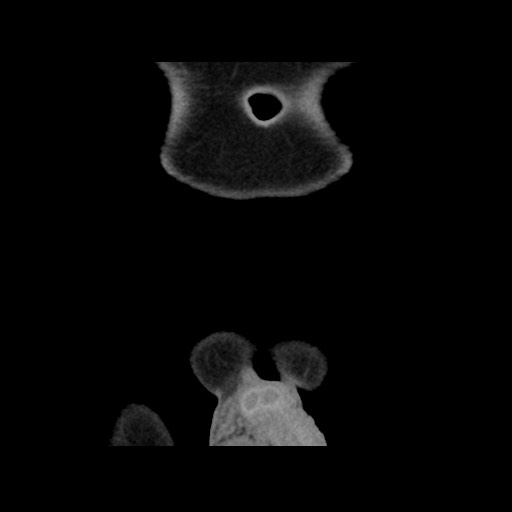 File:Chondrosarcoma of iliac wing (Radiopaedia 63861-72599 Coronal non-contrast 13).jpg