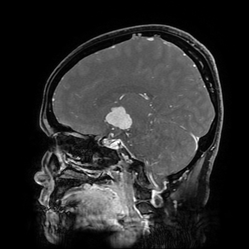 File:Chordoid glioma of third ventricle (Radiopaedia 91612-109340 F 121).jpg